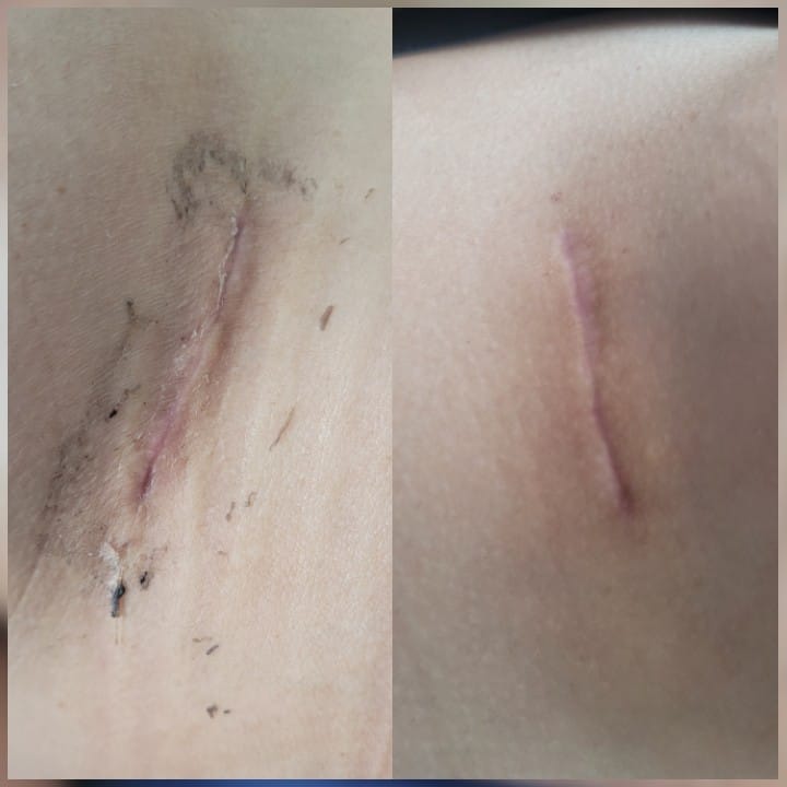 Pos Operatorio de Mamoplastia de Aumento