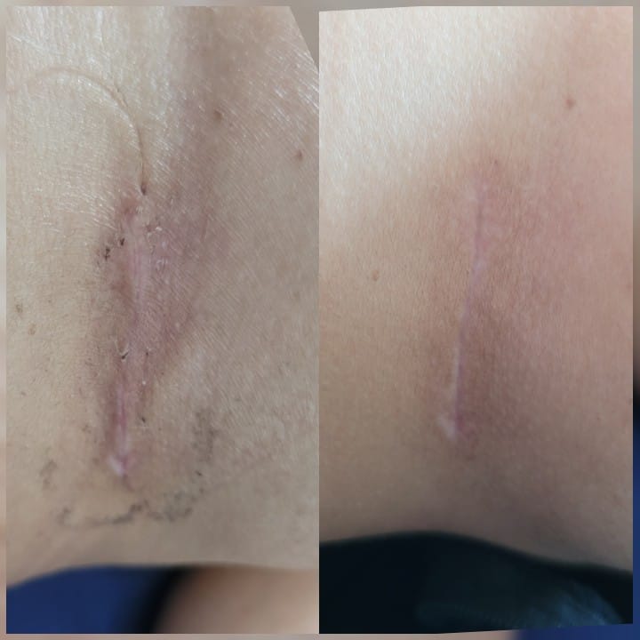 Pos Operatorio de Mamoplastia de Aumento