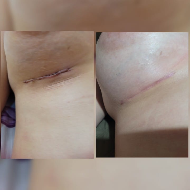 Pos Operatorio de Mamoplastia de Aumento