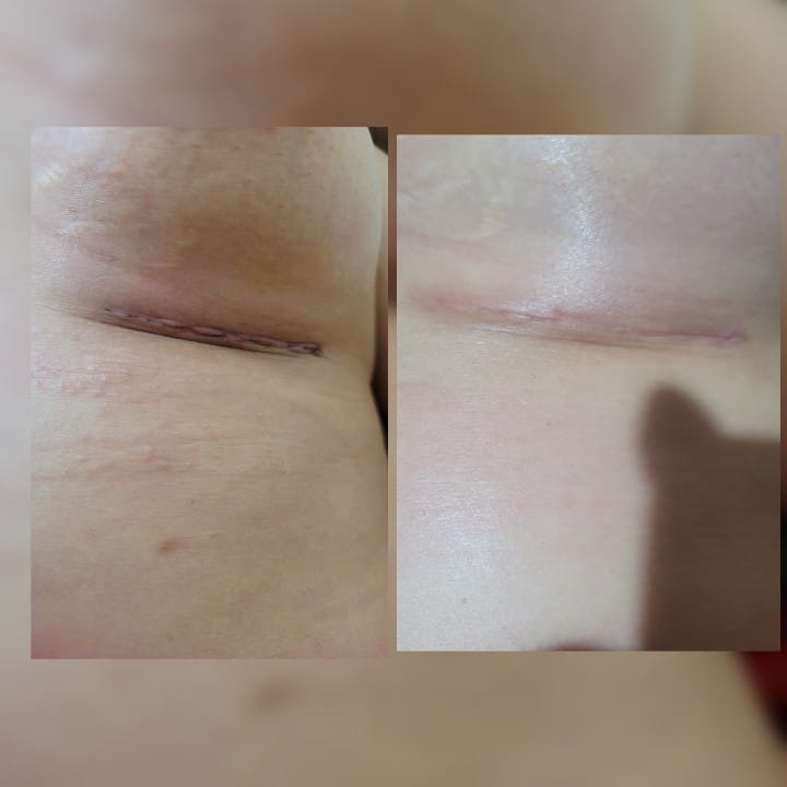 Pos Operatorio de Mamoplastia de Aumento